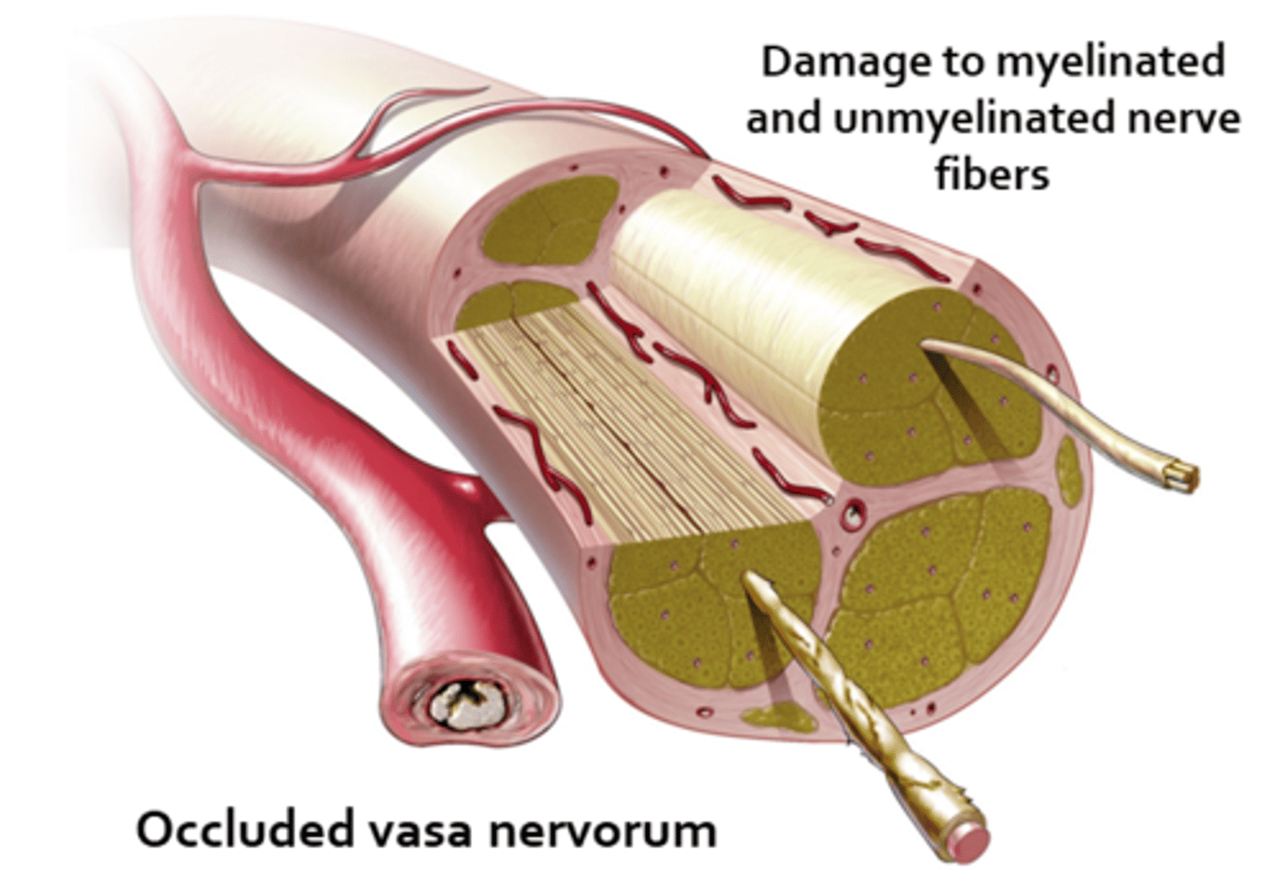 <p>vasa nervorum occlusion = infarcation of these small BV = focal areas of demyelination in the nerve core, while the outer pupillomotor fibers are spared</p>
