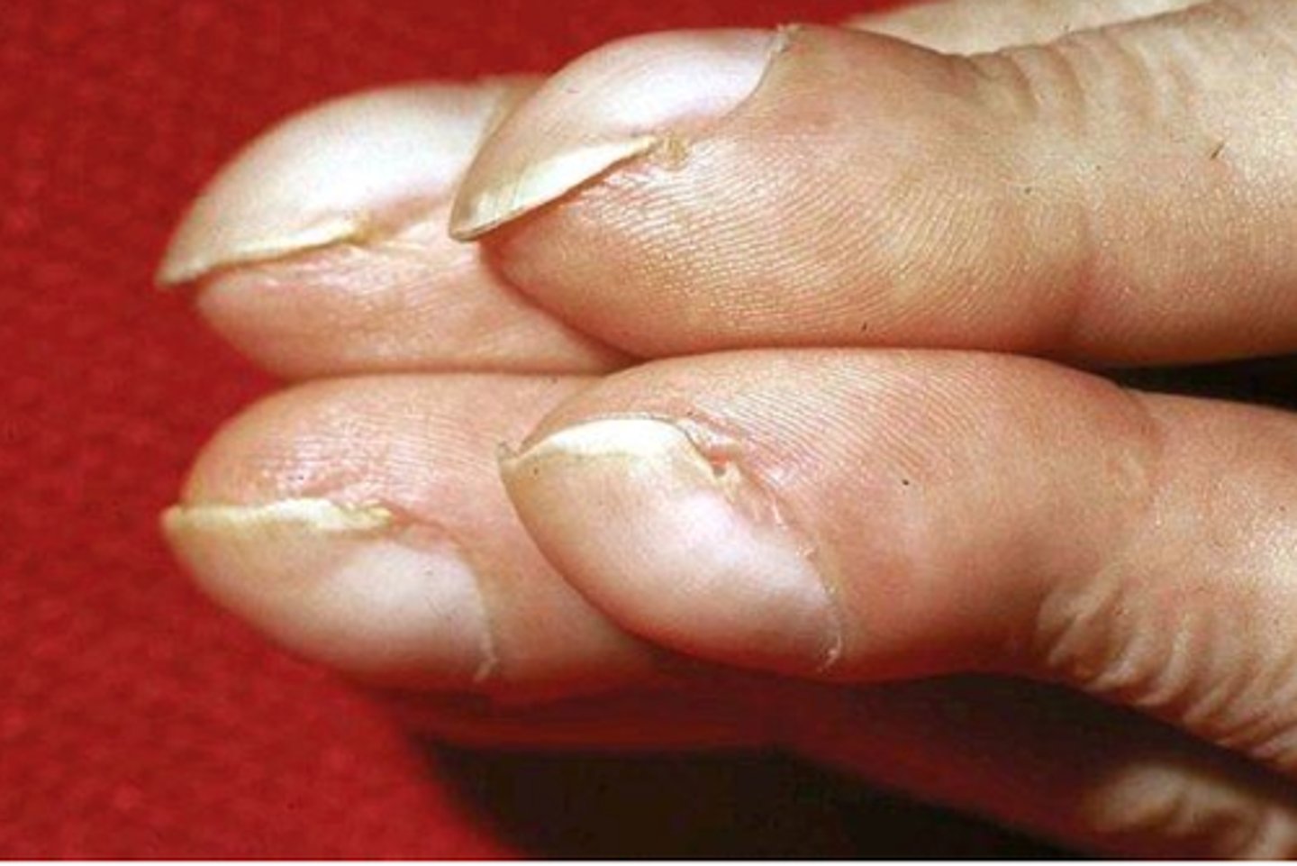 <p>- bulbous swelling of soft tissue at the nail base</p><p>- angle between nail and proximal fold increases</p><p>- nail bed feels like its floating (spongy)</p>