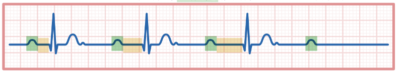 <p>What does this refer to</p><p>“PR intervals gradually elongate until a P-wave is completely blocked</p>
