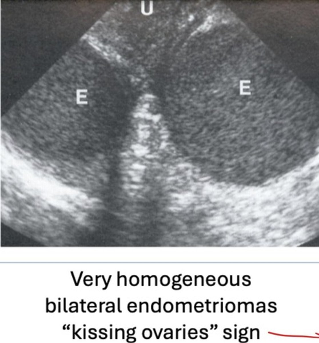 <p>- Both ovaries adjacent due to adhesions in pelvis</p><p>- Associated with endometriosis/endometriomas</p>