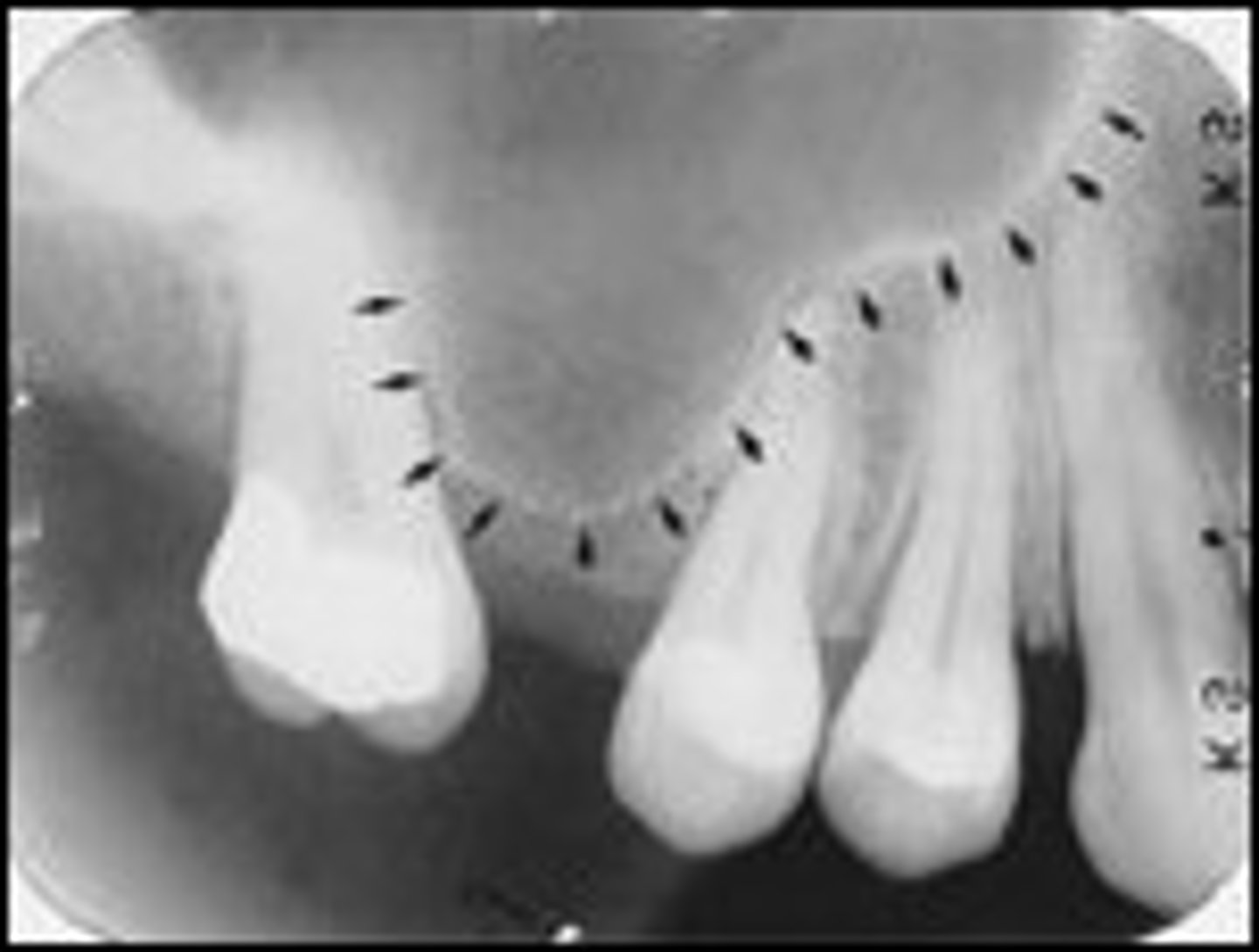 <p>apices of max molars</p>