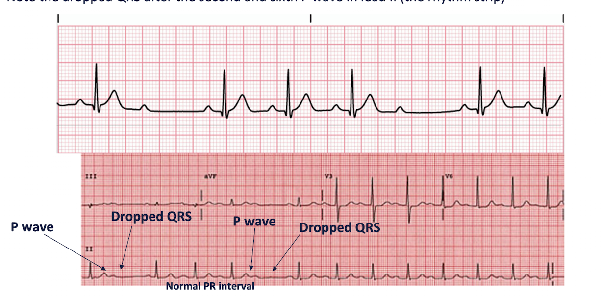 <ul><li><p>AKA:</p><ul><li><p>Mobitz Type 2</p></li></ul></li><li><p>Characteristics:</p><ul><li><p>Disease of the Bundle of His and Purkinje FIbers </p></li><li><p>PR Intervals are CONSTANT and QRS is “DROPPED” INTERMITTENTLY</p></li><li><p>NO PATTERN CAN BE DISCERNED (unpredictable) </p></li></ul></li></ul><p></p>
