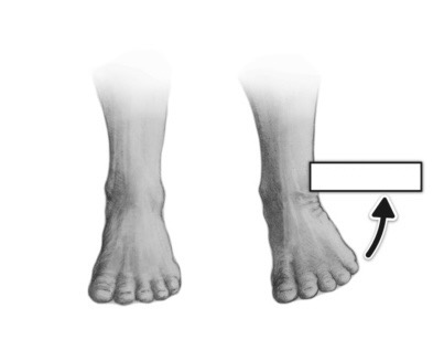 <p>turning sole of foot outward/ laterally</p>