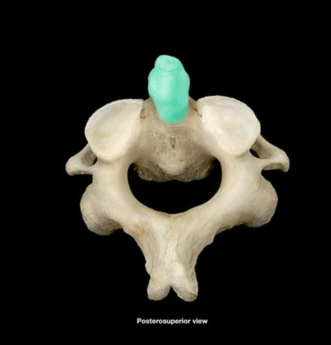 <p>- superior boney projection from the vertebral body</p><p>- pivot point articulating with the atlas (C1)</p>