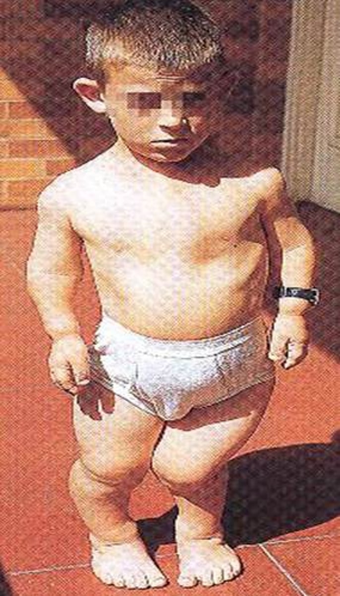 <p>(Dominant)Common form of dwarfism; disorder of bone growth; short limbs; height not exceeding 4 ft; 85% are result of a new mutation</p>