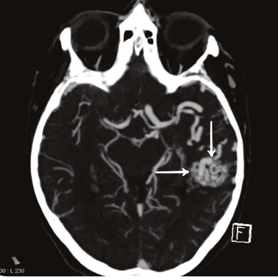 <ul><li><p>angiography</p></li><li><p>CT/MRI </p></li></ul>