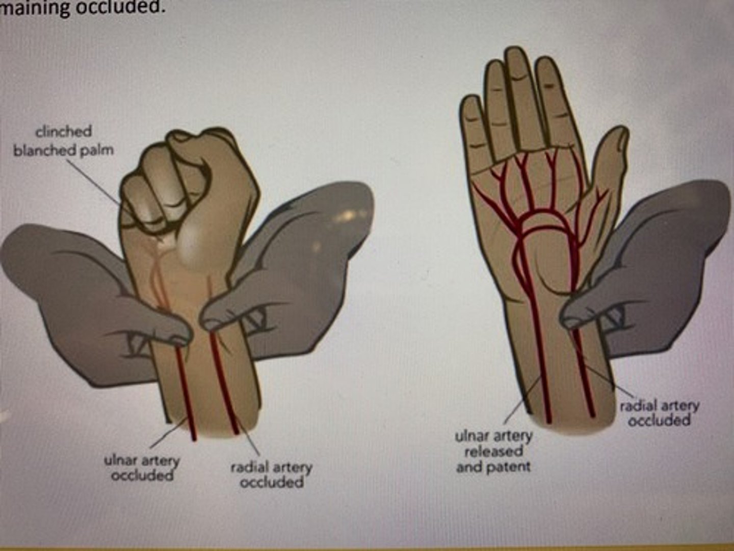 <p>instructions:</p><p>The Allen's test is used to assess collateral blood flow to the hands. This test will take a few minutes to do. First, I will ask you to flex your arm at the elbow, and open and close your hand several times as quickly as possible, and squeeze your hand tightly after. I will compress arteries on both sides of your hand, and will ask you to extend your elbow, and open the hand. We will repeat the same on the other hand.</p>