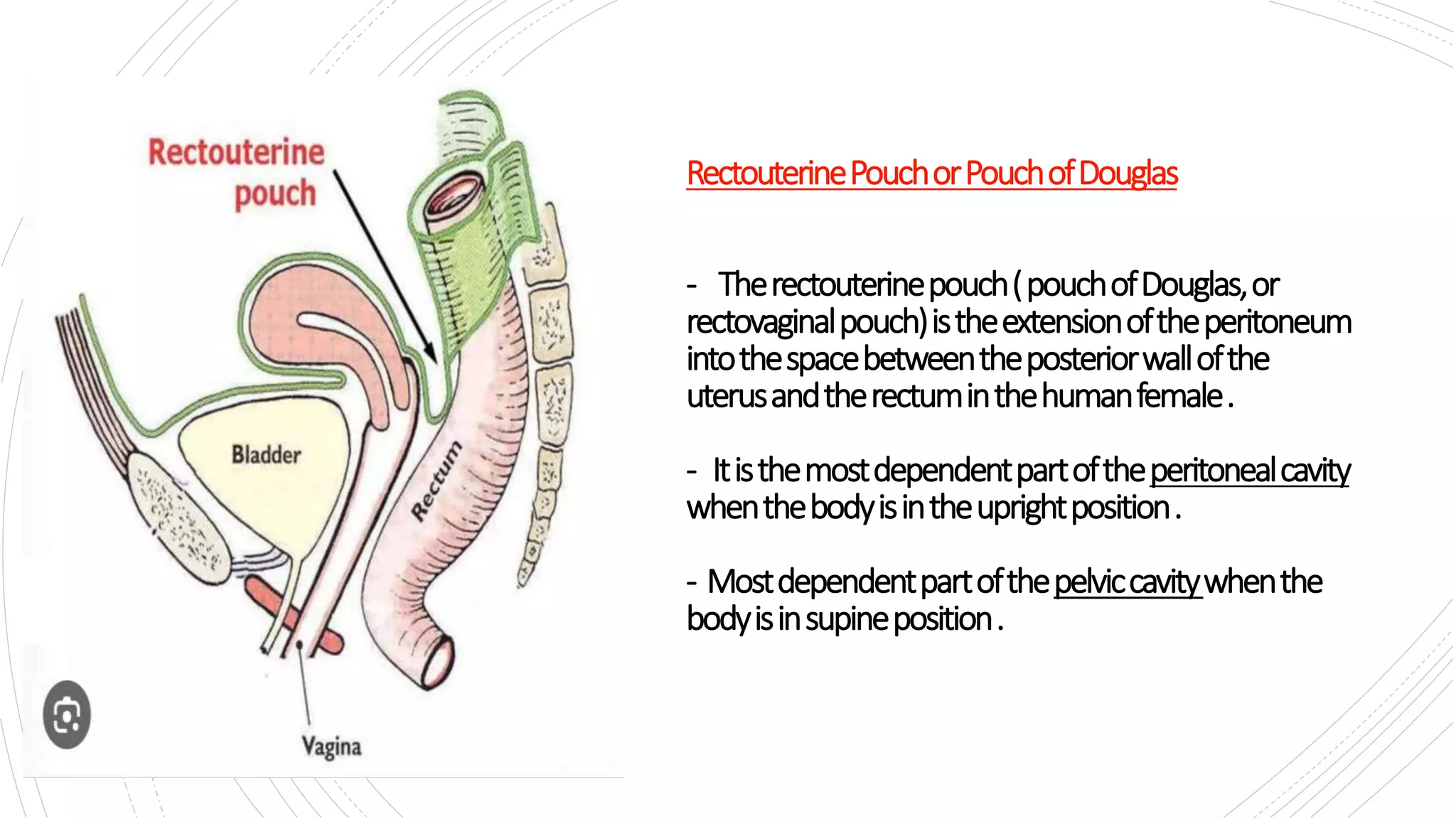 <p>D. vagina</p><ul><li><p>At its deepest point, the peritoneum reflects onto the <strong>posterior vaginal wall</strong>, providing a peritoneal covering to part of the <strong>vagina</strong></p><ul><li><p><strong>urinary bladder</strong> and <strong>urethra</strong> are anterior and covered by the <strong>vesicouterine pouch</strong>, not the rectouterine pouch.</p></li><li><p class="">The <strong>uterine cervix</strong> is covered by peritoneum but the deepest reflection of the rectouterine pouch is onto the <strong>vagina</strong>, especially the posterior fornix.</p></li></ul></li></ul><p></p>
