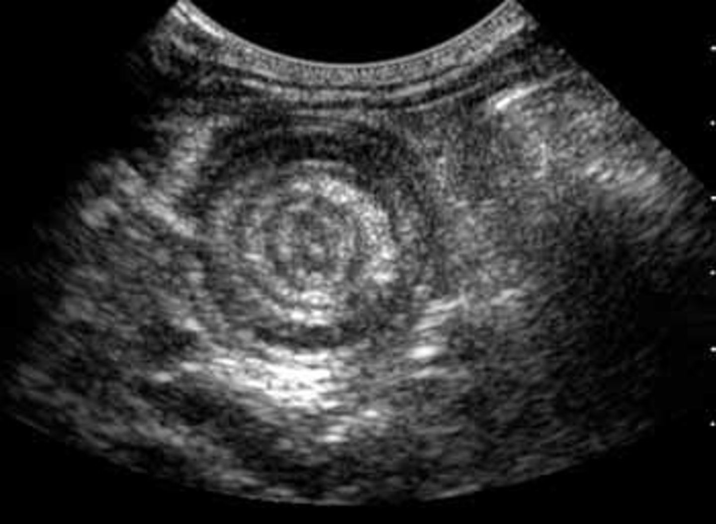 <p>Define Condition:</p><p>One portion of intestine slides inside adjacent part of intestine (telescopes)</p><p>-Hx:</p><p>&gt; 3 mos to 3 y/o</p><p>&gt; ACUTE VIRAL INFEX</p><p>-Path:</p><p>&gt; Acute Virus = Enlargement of Peyer's patches/lymphatic tissue in intestines</p><p>&gt; 90% = ILEOCECAL JUNCTION!!</p><p>-Sx:</p><p>&gt; EPISODIC severe abdominal pain (inconsolable during, "pull legs towards chest") - last 15 to 20 mins</p><p>&gt; BILIOUS VOMITING</p><p>&gt; 20% = Bloody stool (red currant jelly stool) = GI blood + sloughed mucosal cells</p><p>-PE:</p><p>&gt; SAUSAGE (tube)-shaped abdominal mass (90%) d/t being at Ileocecal Junction</p><p>&gt; Lead Point (10%) = mass w/n lumen of intestine (like polyp/tumor/diverticulum); may move forward with peristalsis OR will move part of intestine with it if attached</p><p>-Dx:</p><p>&gt; US = Target Sign/Bull's Eye Sign/Donut Sign/Coiled Spring Sign (one segment of bowel w/n another segment)</p><p>&gt; Contrast (Barium) Enema</p><p>-Tx:</p><p>&gt; Therapeutic Enema</p><p>&gt;&gt; Tube in rectum --&gt; Air/Saline/Contrast forced in to "un-telescopes" in intestines</p><p>&gt; Abdominal Surgery (if enema fails)</p>