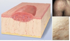 <p>dark skin</p><p>somewhat irregular shape associated with edema, superficial, transient, erythematous, and raised</p><p>ex: mosquito bite</p>