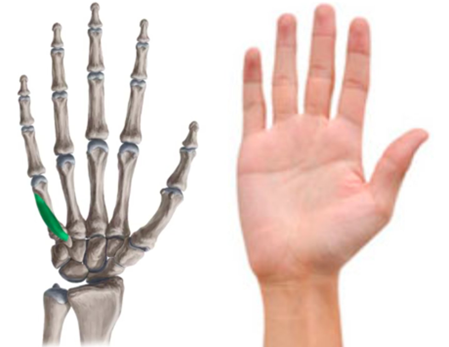 <p>body of 5th metacarpals</p>