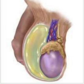 <p><strong>Hydrocele</strong></p><p>-___________ scrotal swelling due to _____ collecting in the sheath surrounding the testicle </p><p>-Common in newborns, usually resolving by age 1. In older children and adults, may develop due to ____________ or scrotal injury </p><p>-Inspection → mass does transilluminate with ____ or red glow</p><p>-Palpation → _________ mass </p>
