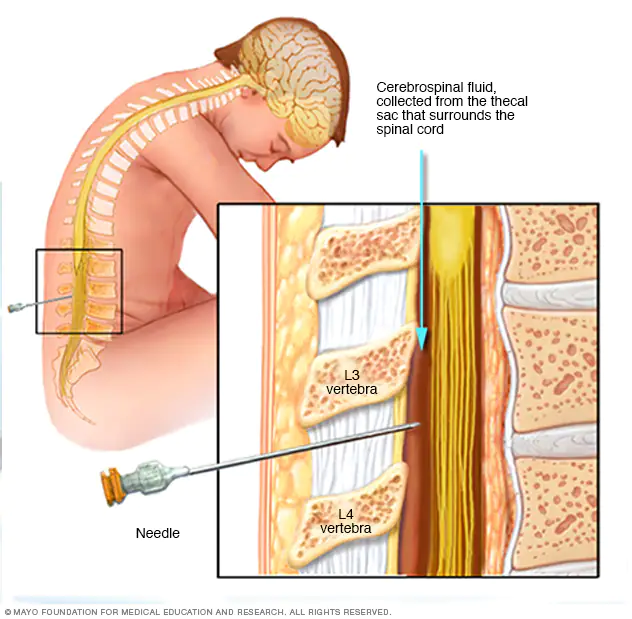 <p>Needle passes through Skin, back muscles, ligamentum flavum</p>
