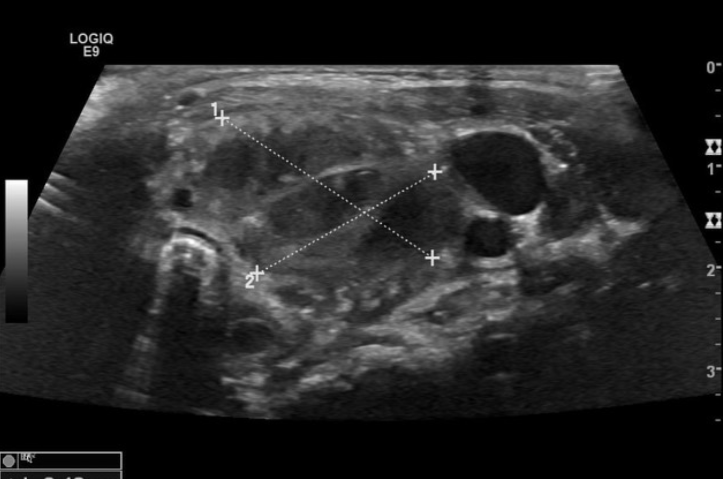 <p>Patient presents to the ED for neck pain and general malaise. Her symptoms started 3 hours ago. Vitals are stable with the exception of a temp of 104.3. Physical exam reveals, a painful, erythematous thyroid. Lab work shows elevated PMNs, elevated ESR and CRP, leukocytosis, TSH is in range. See U/S. What is your management plan?</p>