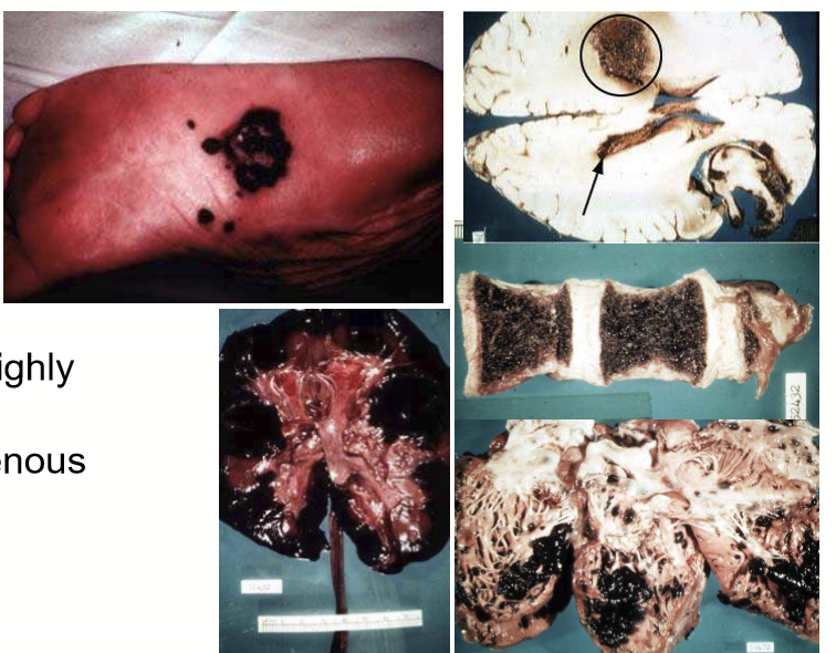 <p>Highly metastatic: hematogenous spread </p>