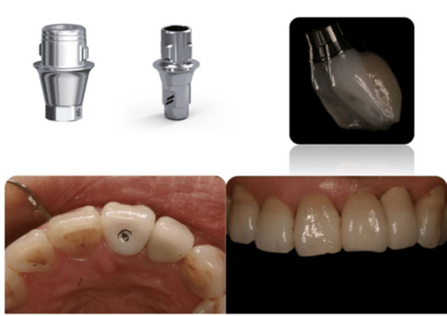 <p>ID the type of restoration:</p><p>- Secured directly onto implant</p><p>- Screw-retained</p><p>- Porcelain veneered over a Zr CAD/CAM engaging abutment (designed to support veneering porcelain)</p><p>- *The crown shown is layered but it can also be monolithic</p><p>- - Check lecture on Dental Porcelain</p>