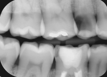<ul><li><p><span style="color: #000000">Artifact caused by differential contrast between more opaque enamel and less opaque dentin</span></p><ul><li><p><span style="color: #000000">Optical illusion from differential stimulation and inhibition of neighboring receptors in retina</span></p></li><li><p><span style="color: #000000">Retinal receptors overstimulated by enamel opacity inhibit adjacent receptors that perceive more radiolucent dentin</span></p></li></ul></li><li><p><span style="color: #000000">Results in perception of a radiolucent band in the superficial dentin adjacent to DEJ</span></p></li><li><p><span style="color: #000000">To overcome Mach-band effect</span></p><ul><li><p><span style="color: #000000">Mask the more radiopaque enamel</span></p></li><li><p><span style="color: #000000">If the radiolucent band disappears, not caries</span></p></li><li><p><span style="color: #000000">If continues to be seen, caries</span></p></li></ul></li><li><p><span style="color: #000000">If lesion visible only on image without clinical evidence</span></p><ul><li><p><span style="color: #000000">Monitor/observe to avoid unnecessary treatment</span></p></li></ul></li></ul><p></p>