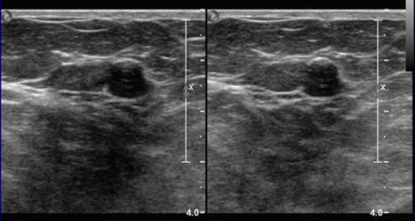 <ul><li><p>suspicious, tissue diagnosis (biopsy)</p></li><li><p>image: US does not show all the features of a fibroadenoma, no posterior enhancement</p></li></ul><p></p>