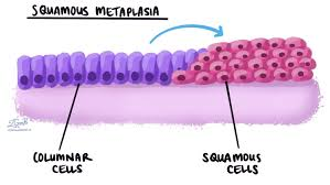 <p>where one adult cell type is replace by another cell type</p><p><strong>e.g.</strong> columnar to squamous in respiratory tracts of smokers due to chronic irritation (precursor to neoplasia if irritation persists)</p>