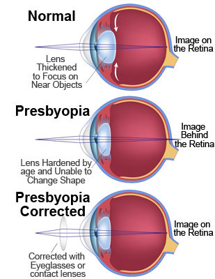 Presbyopia
