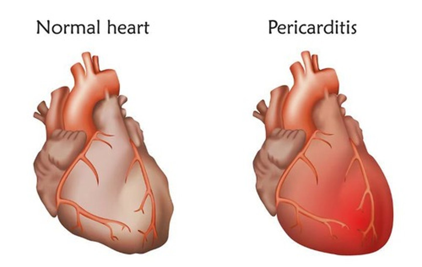 <p>Inflammation of the pericardium—the membranous sac around the heart.</p>