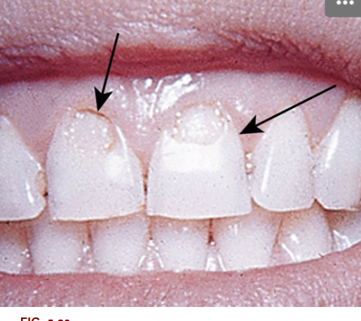 <p>6. What tooth tissue is seen in Fig. 5.23 that is yellow in color?</p><p>a. Enamel</p><p>b. Dentin</p><p>c. Cementum</p><p>d. Pulp</p>