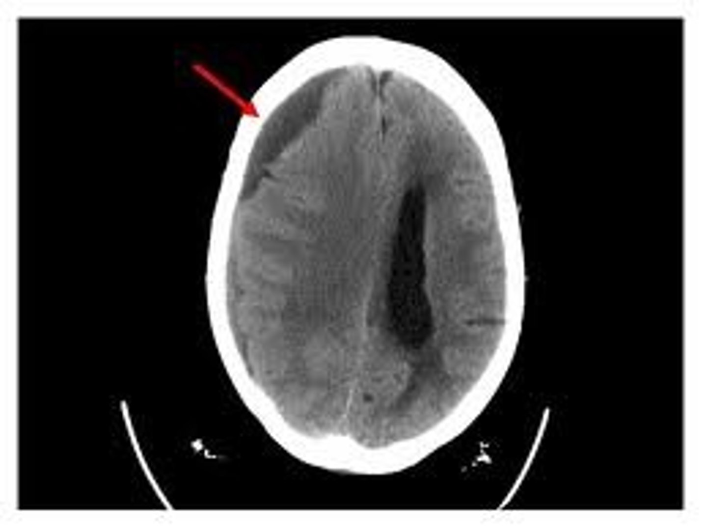<p>space between dura mater and arachnoid mater</p>