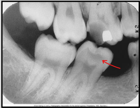<p>Classify this carious lesion</p>
