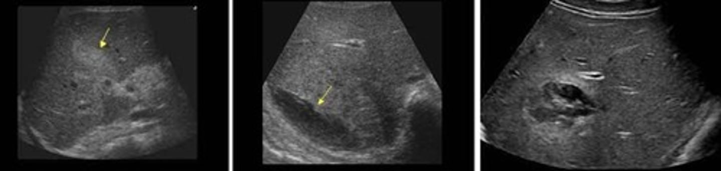 <p>Fresh - hyperechoic</p><p>Older - cystic/anechoic and possibly complex</p>