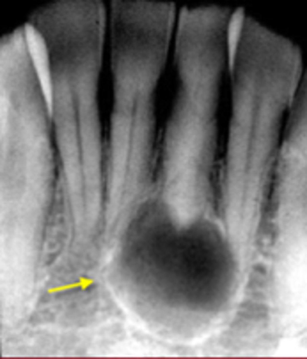 <p>ID the cyst:</p><p>- Radiolucent lesion</p><p>- Well defined, corticated borders</p><p>- Hydraulic/round</p><p>- Periapical in location (apex of a non vital tooth)</p>