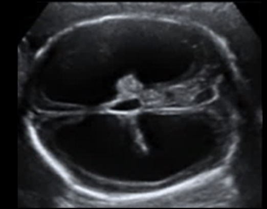 <p>what is the most common cause for this abn</p><p>a) spina bifida</p><p>b) aqueductal stenosis</p><p>c) mass effect from neuroblastoma</p><p>d) chiari malformation </p>