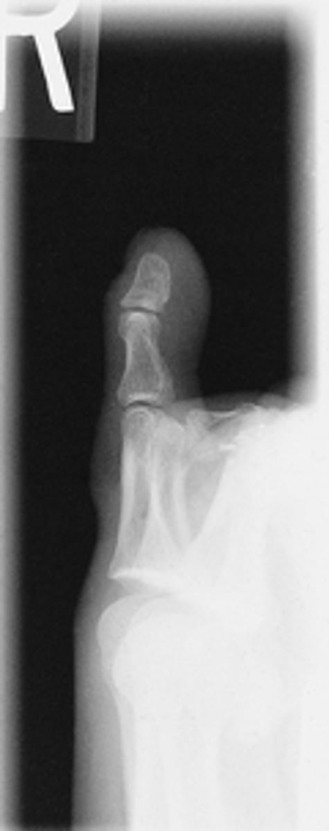 <p>- CR to PIP</p><p>- Mediolateral</p><p>- Digits presented in true lateral position</p><p>- IP and MTP joints appear open</p><p>- Digit free of superimposition</p><p>- Optimal exposure factors</p>