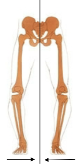 <p>distal segment (foot) deviates toward midline relative to proximal segemnt </p>