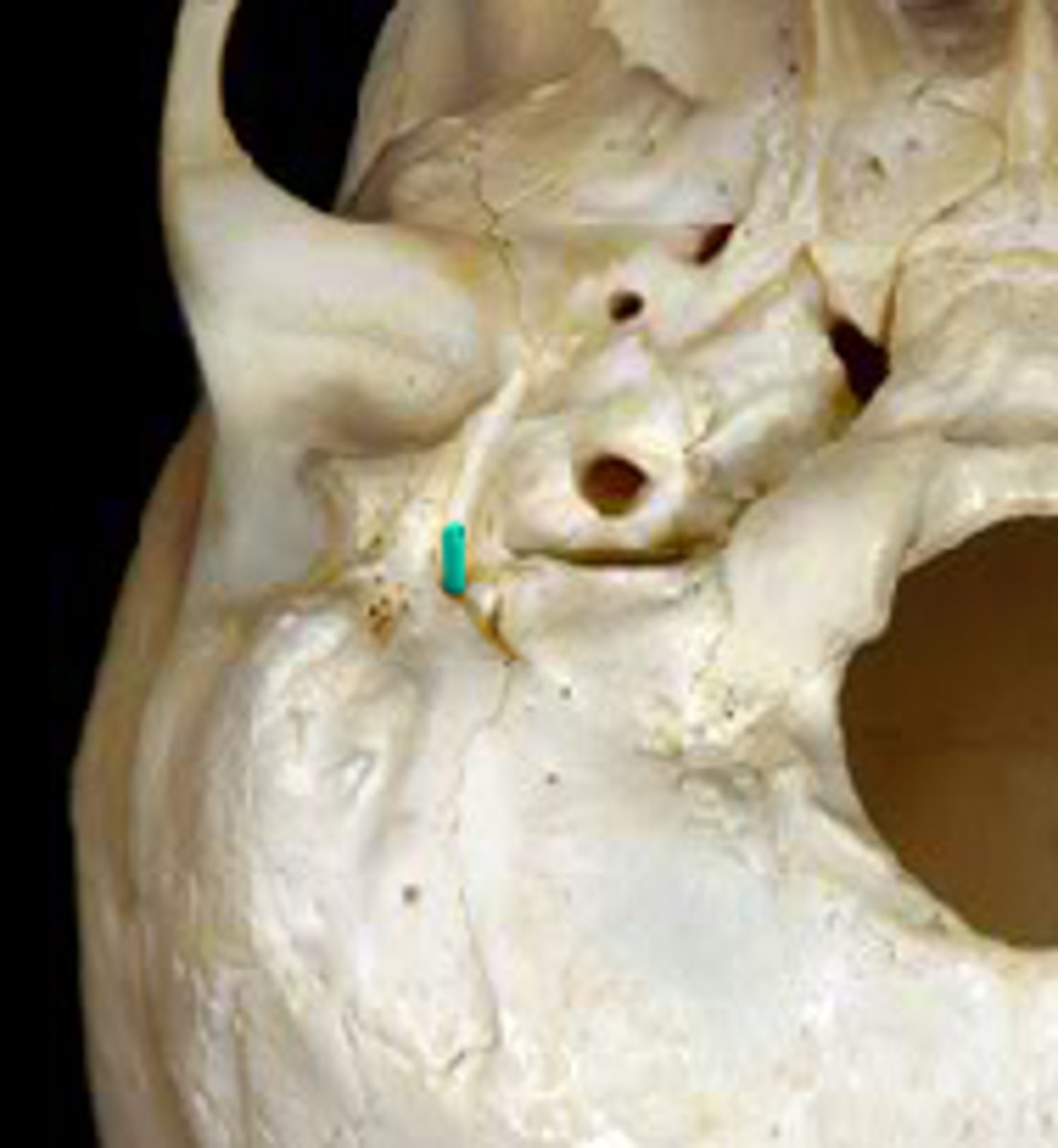 <p>Continuous w/ Internal Acoustic Meatus</p>