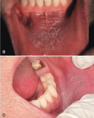 <p>well-demarcated keratotic plaques</p><ul><li><p>must biopsy for evaluation of dysplasia</p></li><li><p>regular follow up</p></li></ul><p></p>