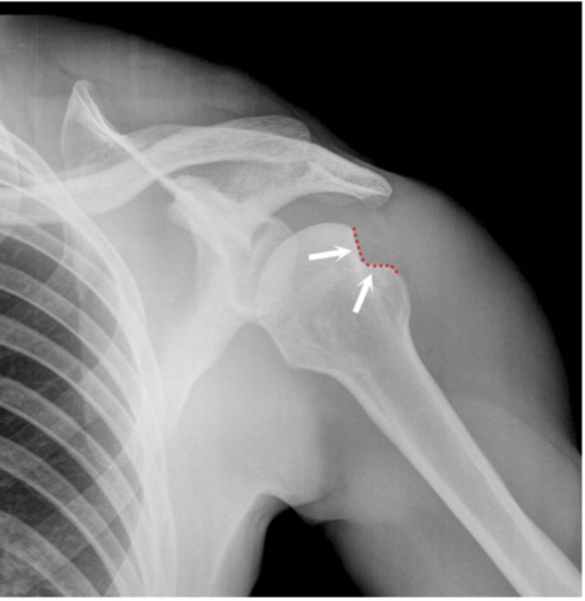 <p>What deformity is seen here</p>