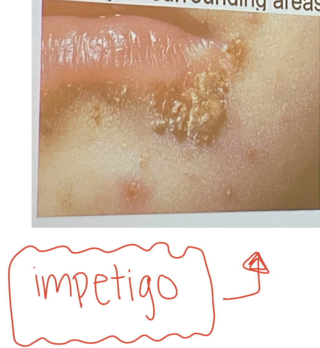 Folliculitis/Impetigo: Staphylococcal skin infection