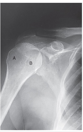 <p>position of humerus?</p>