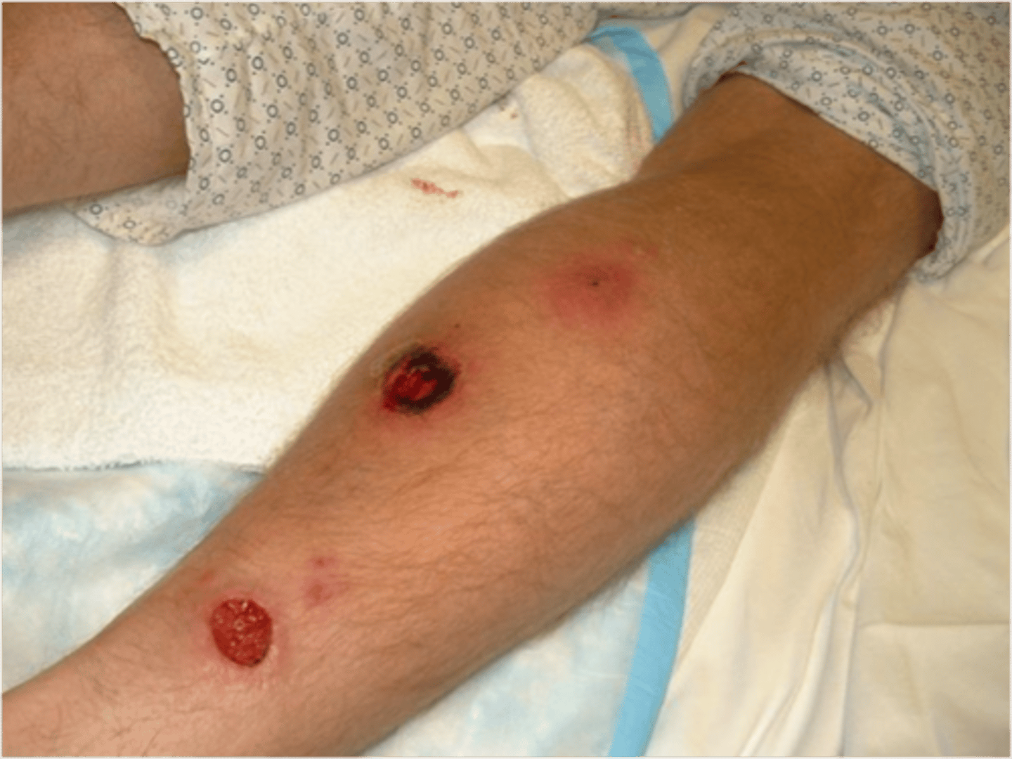 <p>Deep form of impetigo with ulceration extending into dermis - “punched out” appearance with thick adherent crust</p>
