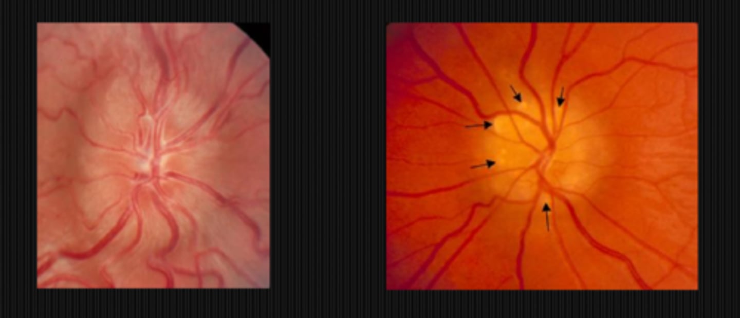 <p>papilledema = hyperemic</p><p>drusen = normal</p>