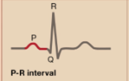 <p>P-R Interval </p>