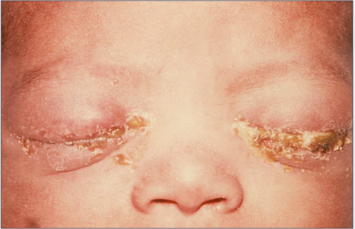 <p>- infection during delivery</p><p>- purulent conjunctivitis</p><p>- preventative application of erythromycin immediately after birth</p>