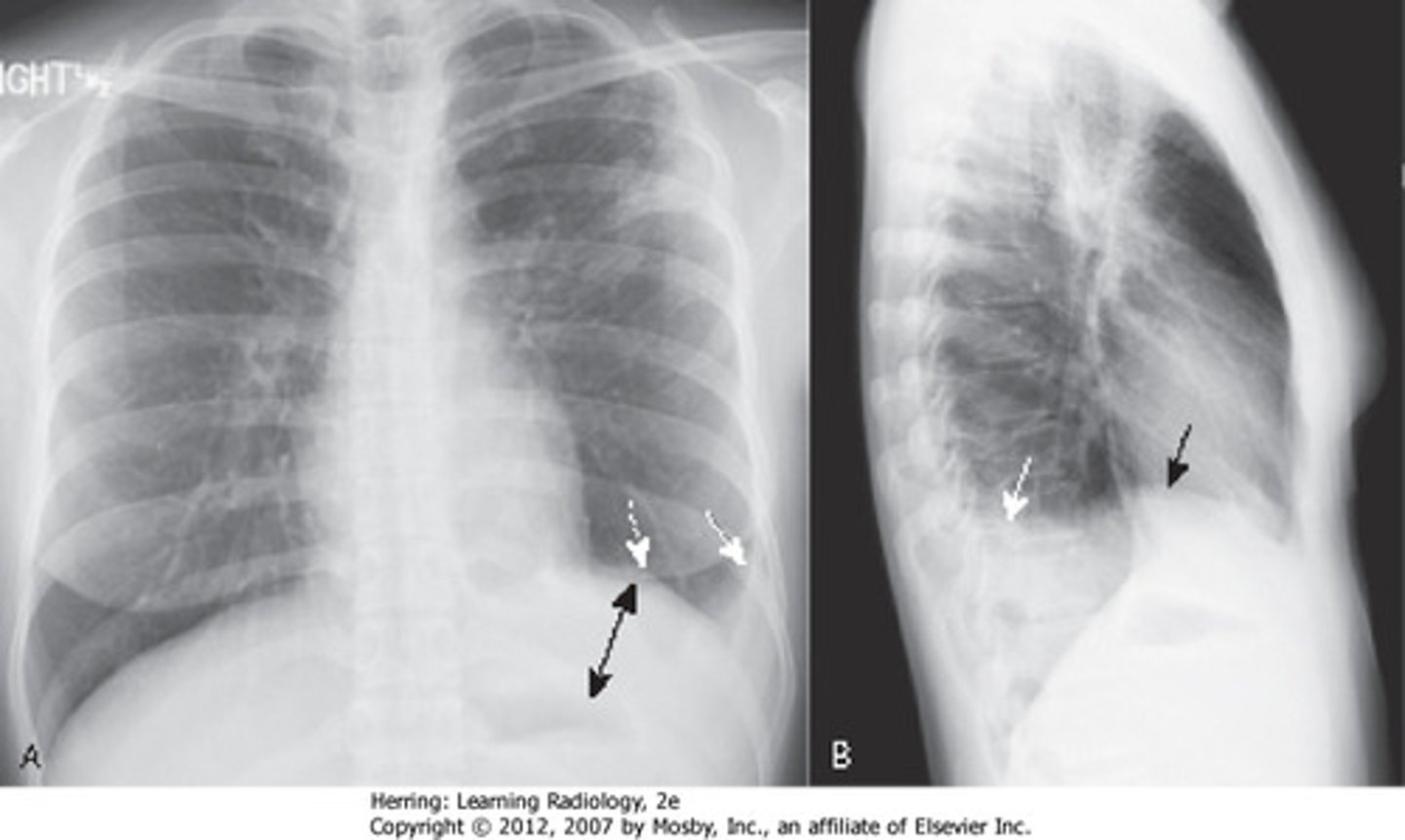 <p>bottom ring of lungs</p>