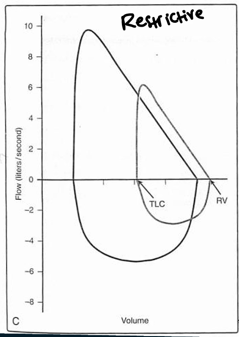 <p>In restrictive disease, the shape of the inspiratory and expiratory curves is <strong>preserved </strong>but the reduced lung volumes shift the curve to the <strong>right</strong>.</p>