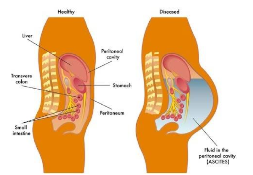 <p>A pathological condition characterized by the accumulation of excess fluid in the abdominal cavity, often due to liver disease, heart failure, or malignancies. </p>