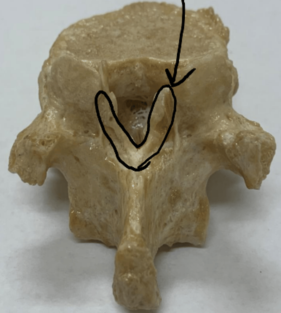 <p>T10 lamina (most common) </p><p>ossification of ligamentum flavum</p>
