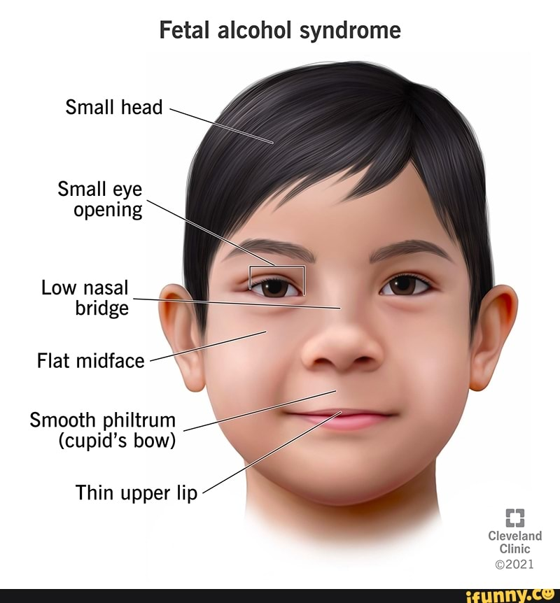 <p><strong><span>alcohol = a teratogenic to the developing fetus</span></strong></p><ul><li><p><span>can cause intellectual disabilities, birth defects, &amp; changes in face and brain structures</span></p></li></ul><p style="text-align: center"><strong><span>Signs:</span></strong></p><ul><li><p><span>small, wide-set eyes</span></p></li><li><p><span>wide flat area between eyes</span></p></li><li><p><span>thin upper lip</span></p></li><li><p><span>upturned nose</span></p></li></ul>