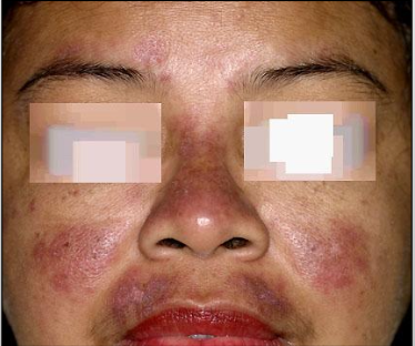 <p>Systemic Lupus Erythematosus</p>