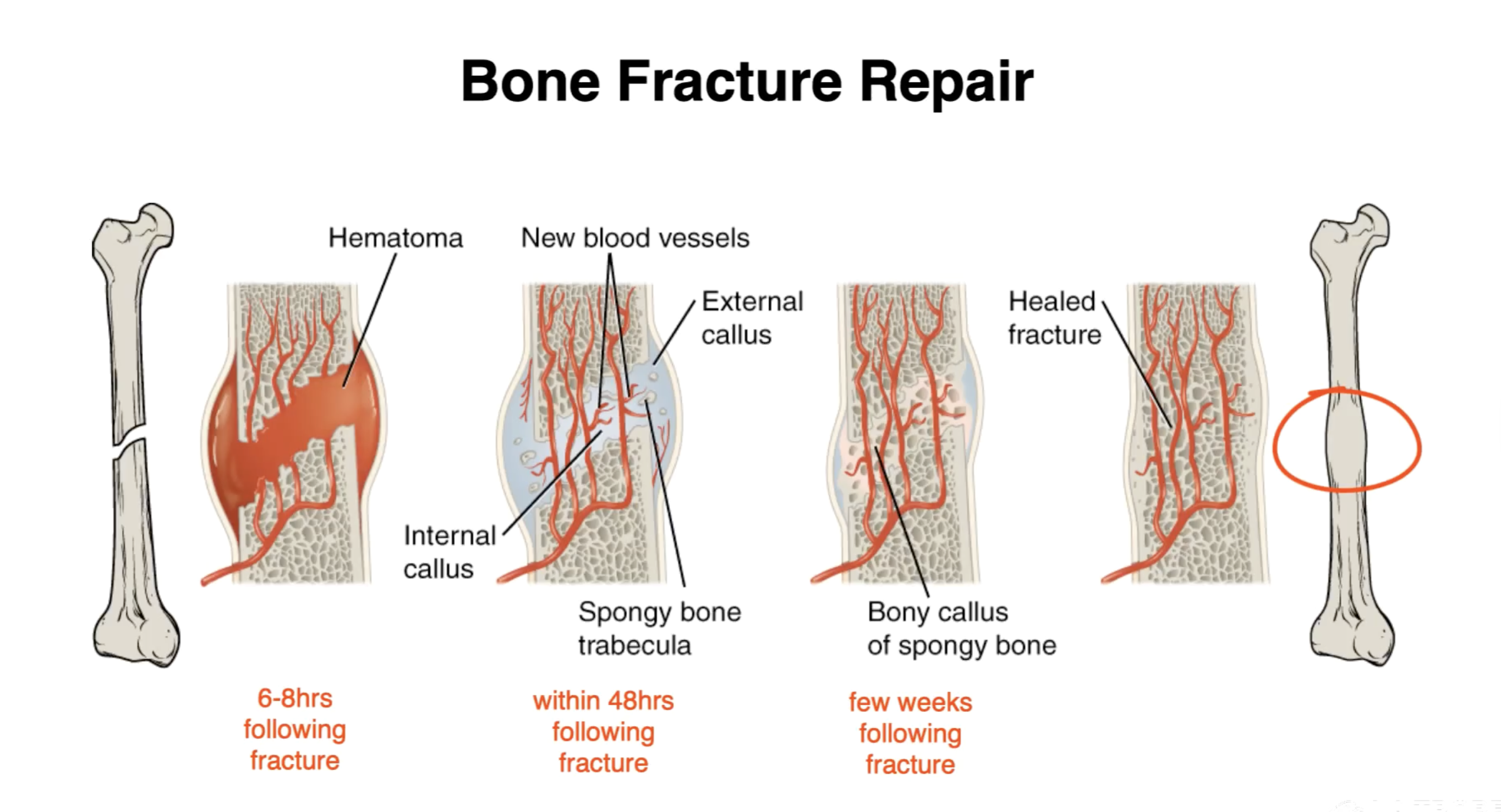 <p>Post-fracture timeline:</p><p>6-8hrs: Fracture Hematoma:</p><ul><li><p>Proximal blood vessel gathers blood which clots around the fracture</p></li><li><p>This limits the ability for new blood to reach the fracture point, causing the bone lining the fracture point to die.</p></li></ul><p></p><p>48hrs: Soft callus:</p><ul><li><p>Internal callus: Chrondrocytes within the endosteum (inner lining of the medullary cavity)</p><ul><li><p>Secrete fibrocartilaginous matrix between the two ends of bone</p></li></ul></li><li><p>External callus: More chondrocytes and osteoblasts</p><ul><li><p>Create hyaline cartilage (chondrocytes) & bone (osteoblasts)</p></li><li><p>This stabilises the fracture</p></li></ul></li></ul><p></p><p>Few weeks later: Hard callus</p><ul><li><p>Osteoclasts absorb dead bone/bony fragments</p></li><li><p>Osteogenetic cells become extremely active</p><ul><li><p>Differentiate into osteoblasts</p></li></ul></li><li><p>Fibrocartilaginous matrix of the internal callus becomes trabecular bone</p></li><li><p>Internal & external callus unite</p></li><li><p>Spongy bone on the outer layers become cortical bone</p></li></ul><p></p><p>Final stage: Bone remodelling</p><ul><li><p>Any swelling of the outer bone undergoes remodelling to return to the normal shape</p></li></ul><p></p>