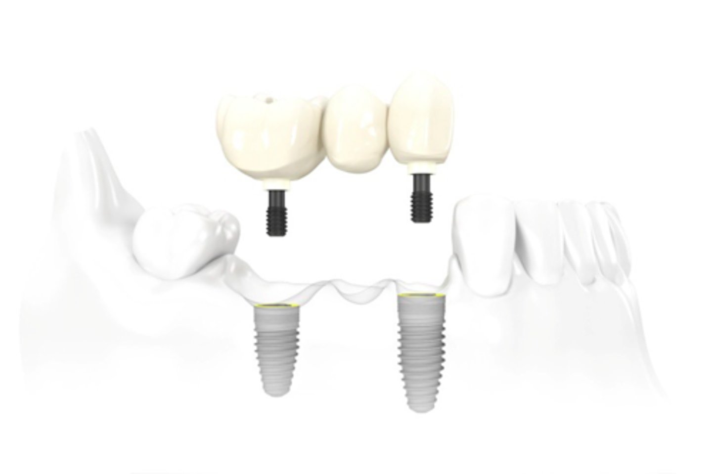 <p>ID the type of implant fixed partial denture:</p>